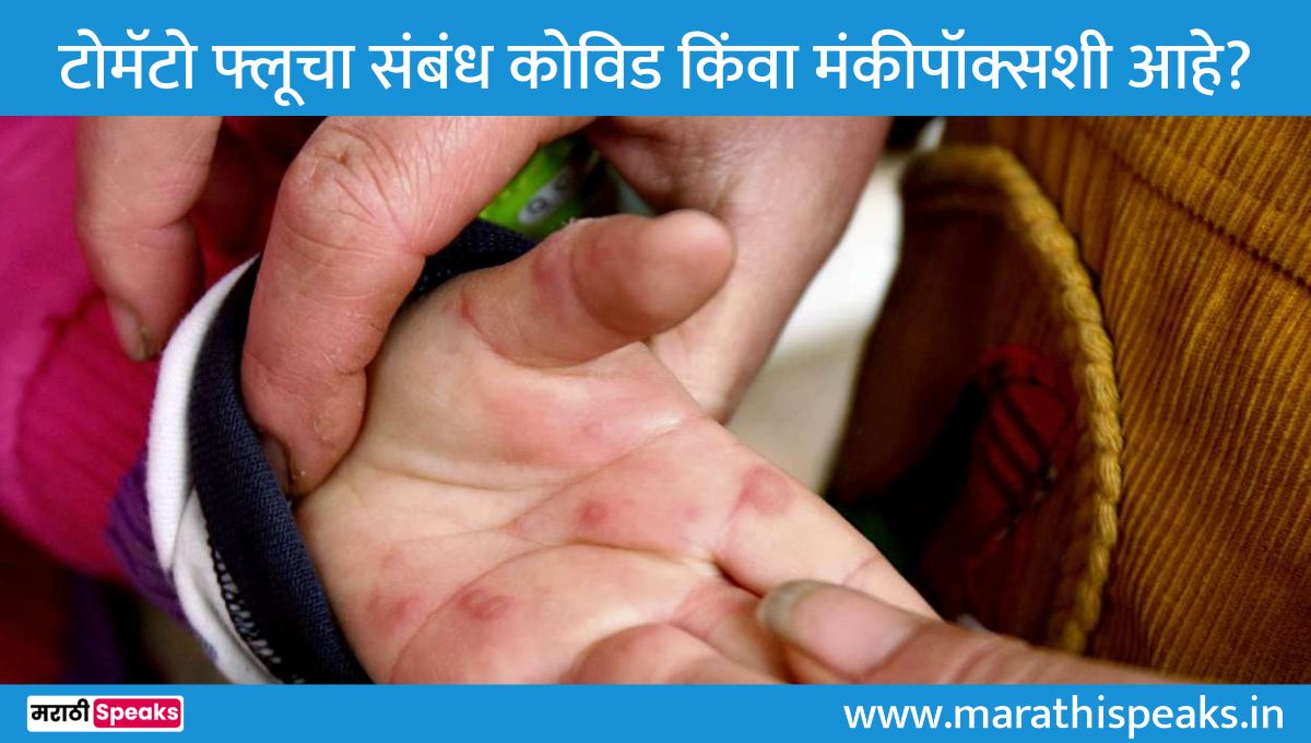 Tomato Flu Symptoms Preventions In Marathi